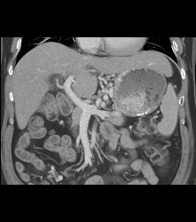 Gastric Varices Simulate A Tumor - CTisus CT Scan