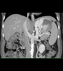 Gastric Varices Simulate A Tumor - CTisus CT Scan