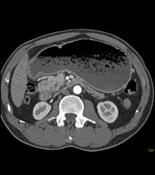 Antral Carcinoma With Gastric Outlet Obstruction - CTisus CT Scan