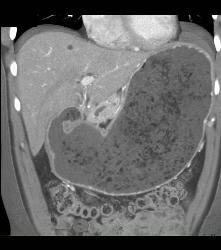 Antral Carcinoma With Gastric Outlet Obstruction - CTisus CT Scan