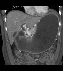 Antral Carcinoma With Gastric Outlet Obstruction - CTisus CT Scan