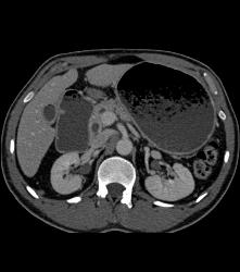 Antral Carcinoma With Gastric Outlet Obstruction - CTisus CT Scan