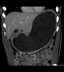 Antral Carcinoma With Gastric Outlet Obstruction - CTisus CT Scan