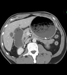 Antral Carcinoma With Gastric Outlet Obstruction - CTisus CT Scan