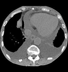 Perforated Gastric Ulcer - CTisus CT Scan