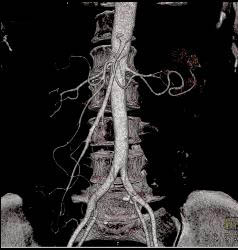 Perforated Gastric Ulcer - CTisus CT Scan