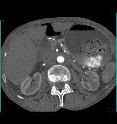 Perforated Gastric Ulcer - CTisus CT Scan