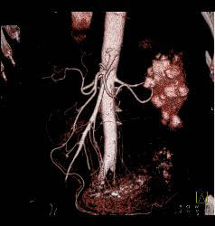 Perforated Gastric Ulcer - CTisus CT Scan