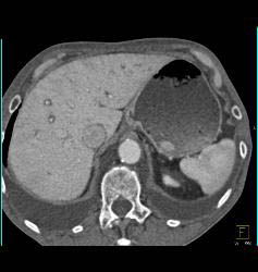 Perforated Gastric Ulcer - CTisus CT Scan