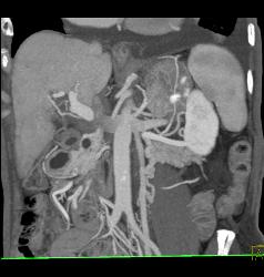 Perforated Gastric Ulcer - CTisus CT Scan