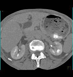 Gastric Cancer With Tube in Antrum Due to Obstruction- See Full Sequence - CTisus CT Scan