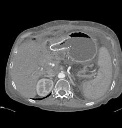 Gastric Cancer With Tube in Antrum Due to Obstruction- See Full Sequence - CTisus CT Scan