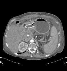 Gastric Cancer With Tube in Antrum Due to Obstruction- See Full Sequence - CTisus CT Scan