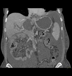 Gastric Cancer With Tube in Antrum Due to Obstruction- See Full Sequence - CTisus CT Scan