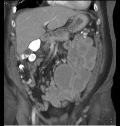 Malrotation With Implants - CTisus CT Scan