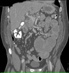 Malrotation With Implants - CTisus CT Scan