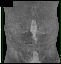 Malrotation With Implants - CTisus CT Scan