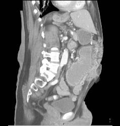 Malrotation With Implants - CTisus CT Scan