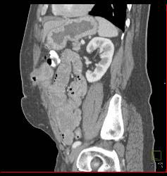 Malrotation With Implants - CTisus CT Scan