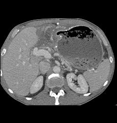 Antral Carcinoma - CTisus CT Scan