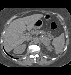 Renal Tumor Spread to Renal Vein and IVC in Patient With Hx of Gastric Cancer - CTisus CT Scan