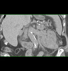 Renal Tumor Spread to Renal Vein and IVC in Patient With Hx of Gastric Cancer - CTisus CT Scan