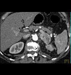 Renal Tumor Spread to Renal Vein and IVC in Patient With Hx of Gastric Cancer - CTisus CT Scan