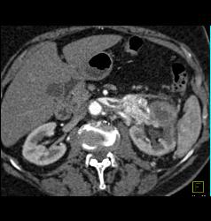 Renal Tumor Spread to Renal Vein and IVC in Patient With Hx of Gastric Cancer - CTisus CT Scan