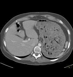 Gastric Outlet Obstruction Due to Antral Carcinoma - CTisus CT Scan