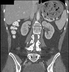 Gastric Outlet Obstruction Due to Antral Carcinoma - CTisus CT Scan