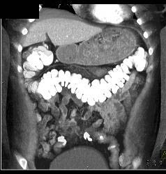 Gastric Outlet Obstruction Due to Antral Carcinoma - CTisus CT Scan