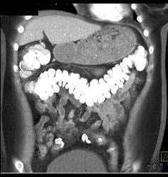 Gastric Outlet Obstruction Due to Antral Carcinoma - CTisus CT Scan