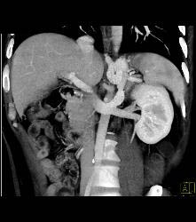 Gastric Varices - CTisus CT Scan