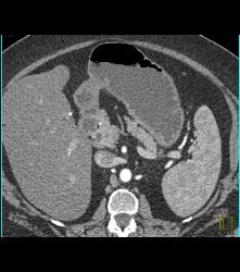 Antral Carcinoma - CTisus CT Scan