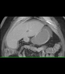 Antral Carcinoma - CTisus CT Scan