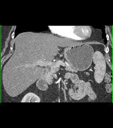 Antral Carcinoma - CTisus CT Scan