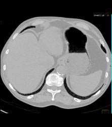 Subtle Gastric Emphysema - CTisus CT Scan