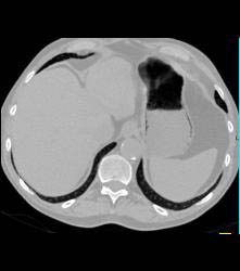 Subtle Gastric Emphysema - CTisus CT Scan