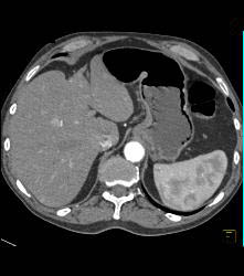 Subtle Gastric Emphysema - CTisus CT Scan