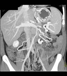 Gastric Varices in Cirrhosis - CTisus CT Scan