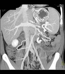 Gastric Varices in Cirrhosis - CTisus CT Scan