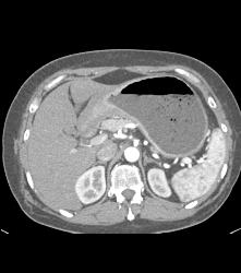 Antral Carcinoma - CTisus CT Scan