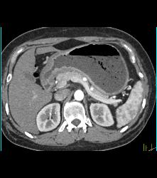 Antral Carcinoma - CTisus CT Scan