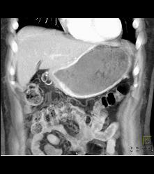 Antral Carcinoma - CTisus CT Scan