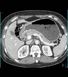 Antral Carcinoma - CTisus CT Scan