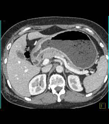 Antral Carcinoma - CTisus CT Scan