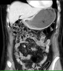 Antral Carcinoma - CTisus CT Scan