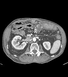 Carcinomatosis on Omentum - CTisus CT Scan