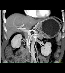 Antral Carcinoma - CTisus CT Scan