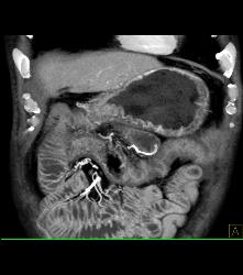 Antral Carcinoma - CTisus CT Scan